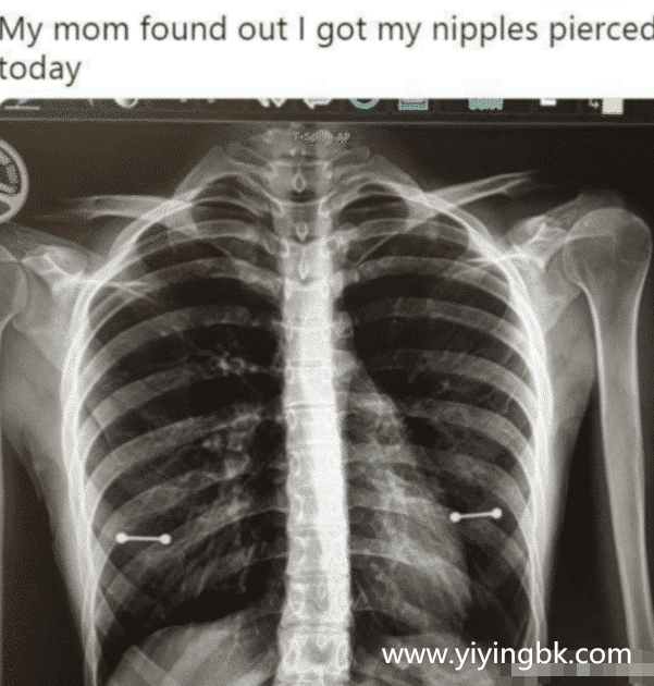 女子照X光多了两根棒棒，医师狂笑妈妈却秒脸黑，网友：糗大了！